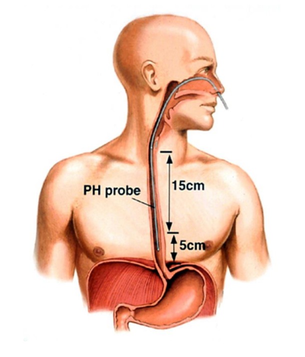 Суточная рН-импедансометрия